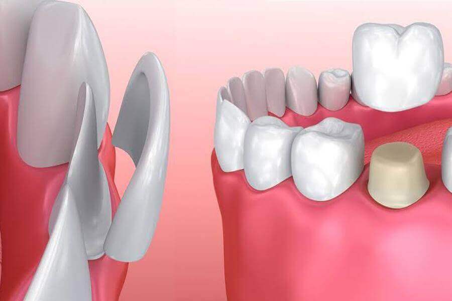 Crowns vs Veneers