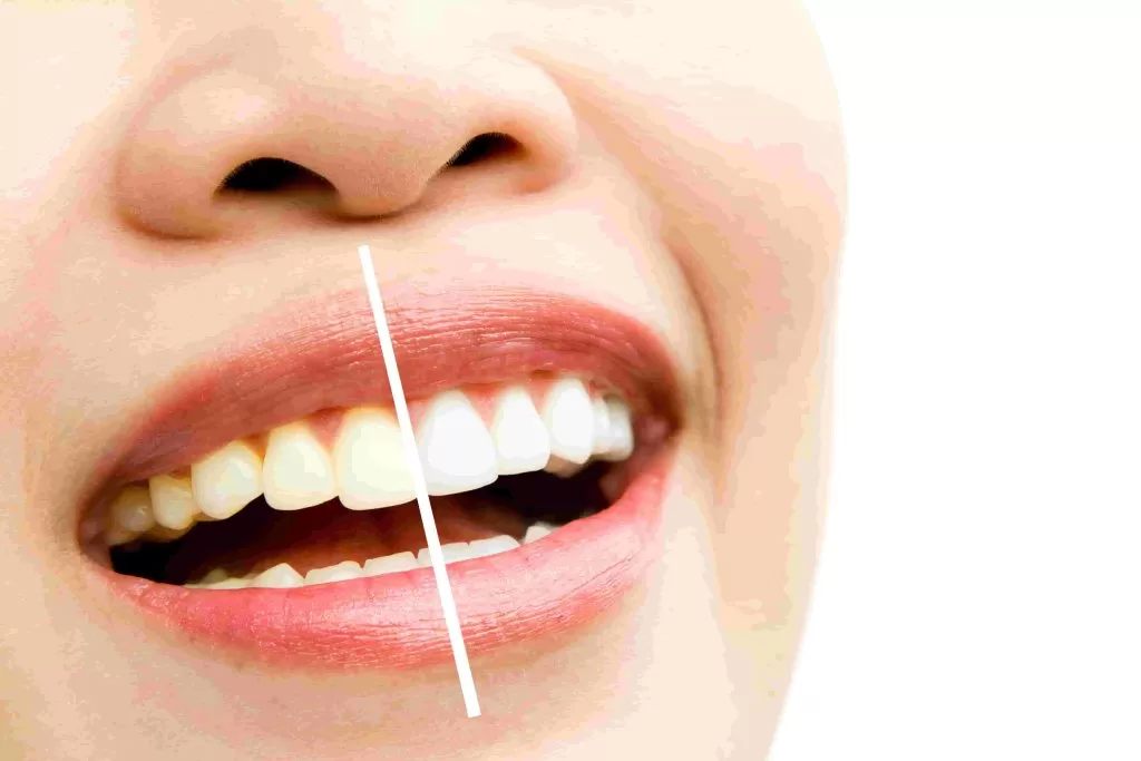 teeth whitening kits