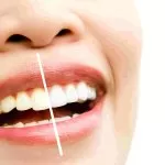 teeth whitening kits
