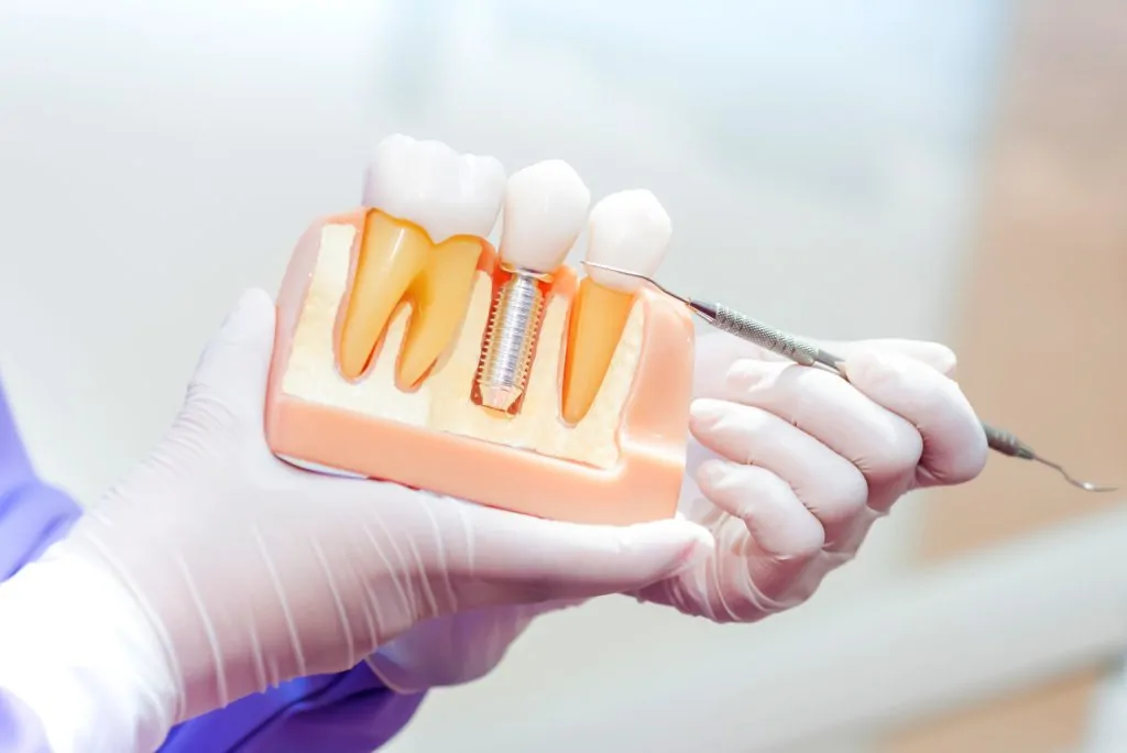 implant supported dentures Australia