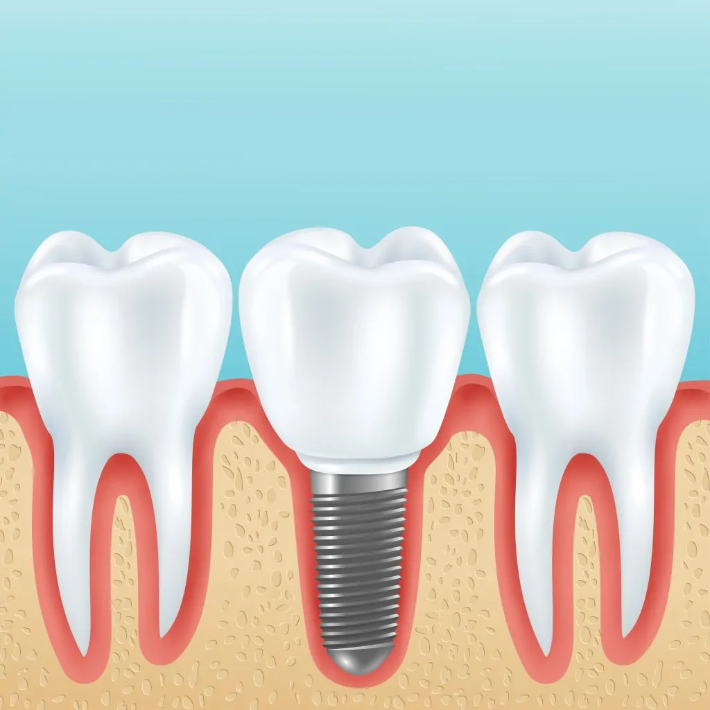 Single Tooth Implant in Australia